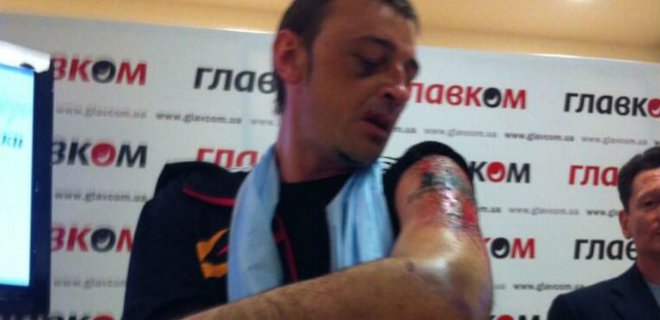 В Донецке террористы битым стеклом срезали шахтеру татуировку - Фото