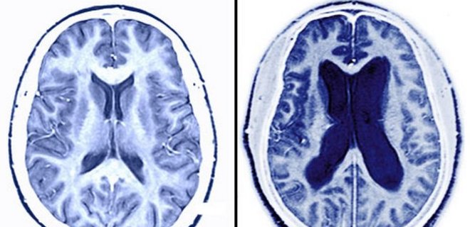 Ученые зафиксировали случаи заражения болезнью Альцгеймера - Фото