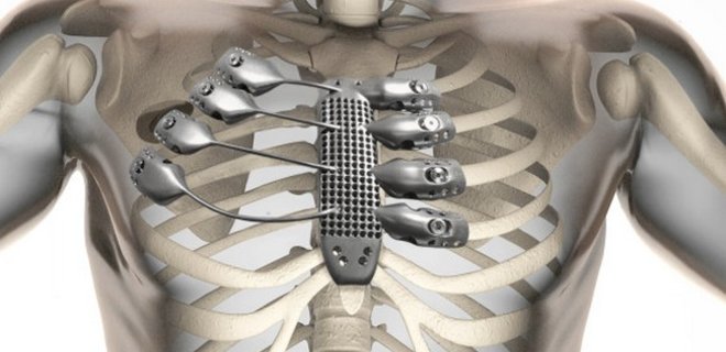 Инженеры напечатали на 3D-принтере фрагмент скелета человека - Фото