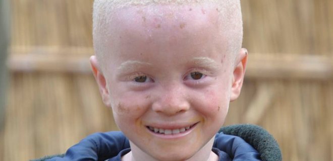 ООН призывает прекратить преступления против альбиносов - Фото