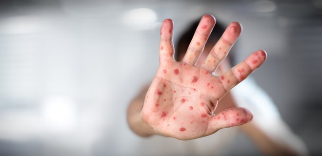 Минздрав предупреждает об эпидемии кори: спасет только вакцинация - Фото