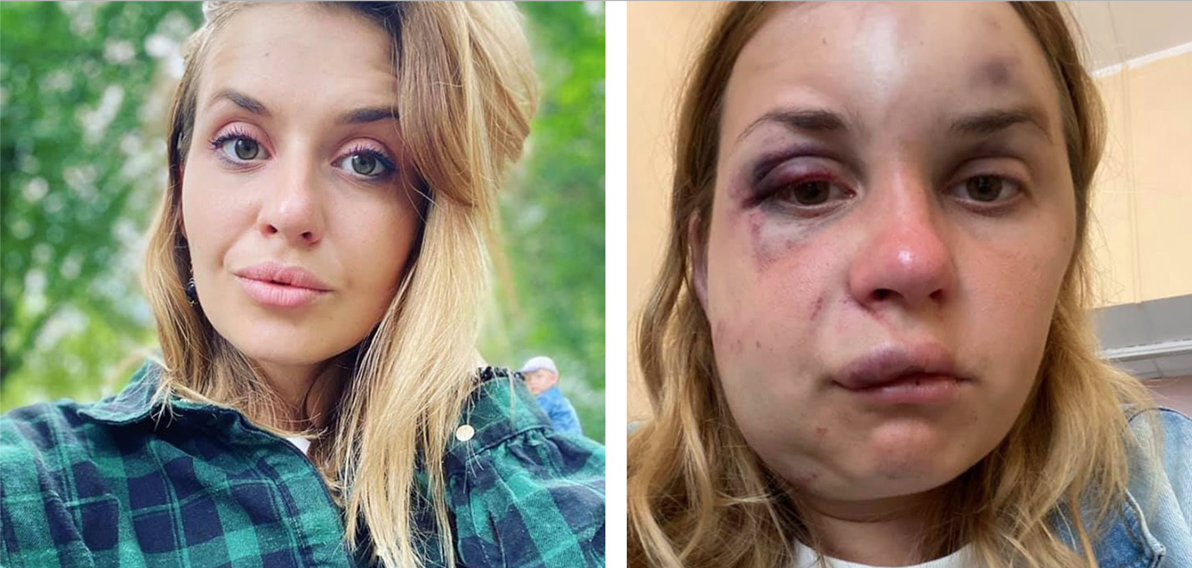 Журналистка Интера рассказала о своем состоянии после нападения ...