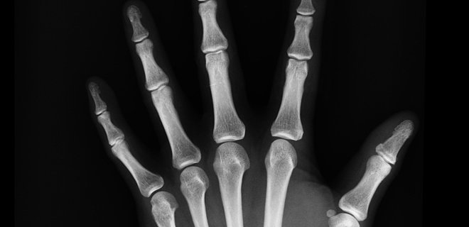 Американцы научились быстрее восстанавливать повреждения костей: в чем суть разработки - Фото