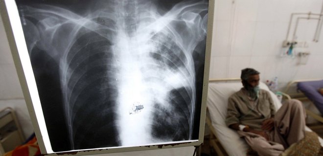 Глобальный прогресс против туберкулеза сорван пандемией коронавируса – отчет - Фото