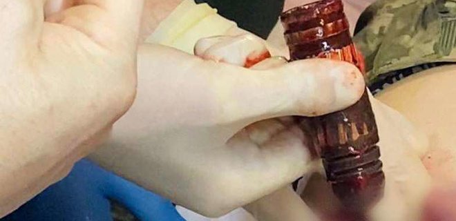 Медики дістали гранату ВОГ з тіла пораненого бійця – фото - Фото